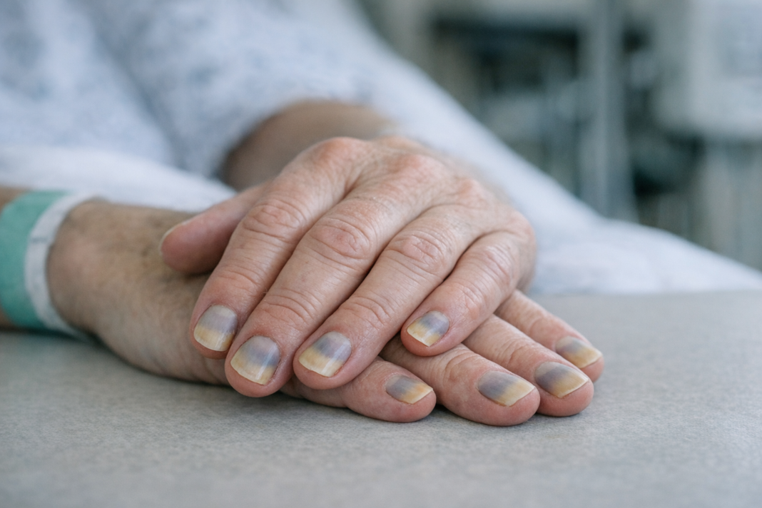 La couleur des ongles peut indiquer des problèmes de santé sous-jacents